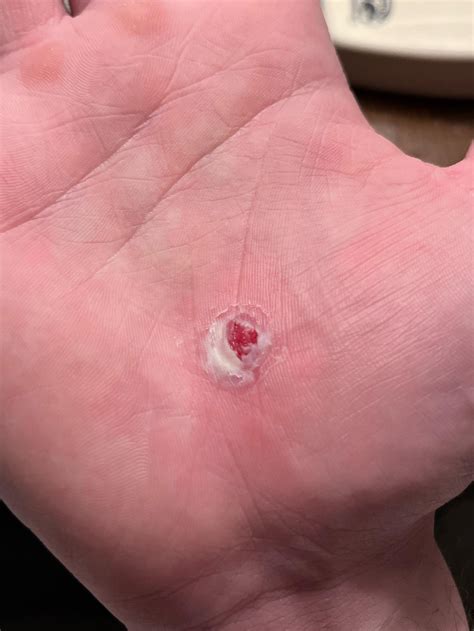 You can literally see the flesh of it : r/Warts