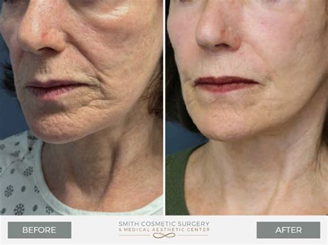 Fat Grafting to the Face Archives - Facial Plastic Surgery Denver