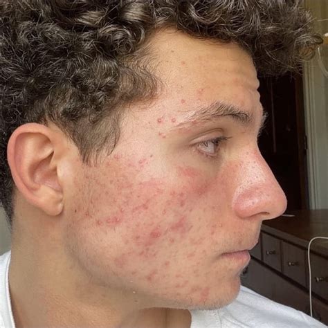 dont  post  heres  acutance progress acne
