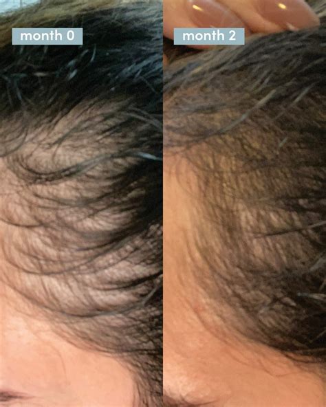 Hers Hair Loss Review - Can it Regrow Your Thinning Hair? - Fin vs Fin