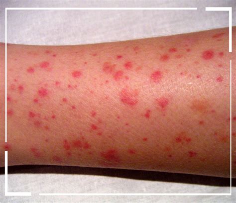 es la purpura trombocitopenica image