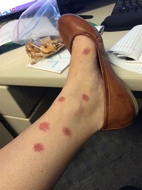 Mosquito Bite Allergic Reaction Treatment at Eddie Avila blog