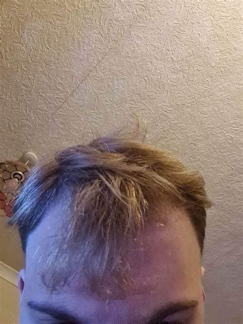 My hairloss treatment progress in 1 year : r/tressless