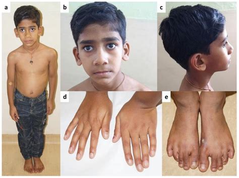 marfan syndrome almurshidi medical tourism  affordable