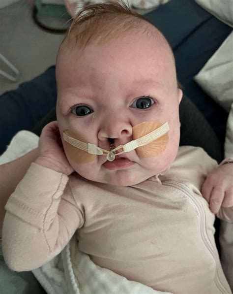 Parents open up after photo of their baby with cleft lip and palate ...