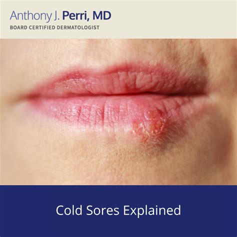 cold sore