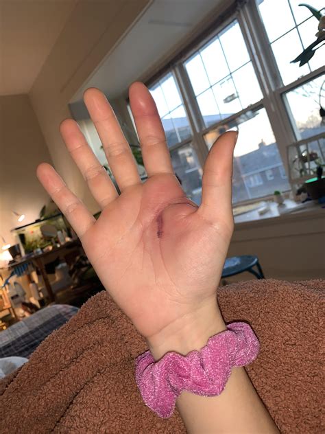 Does this look like chilblains? : r/ReynaudsDisease