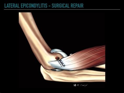 patient education tennis elbow repair louisville bones