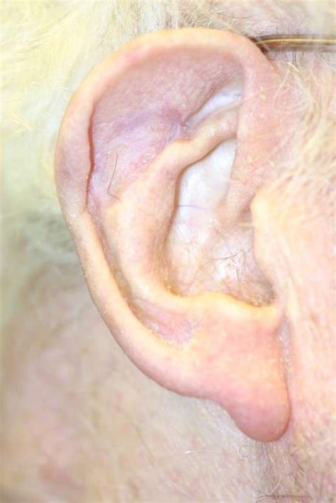 Ear Cancer Pictures - CancerWalls