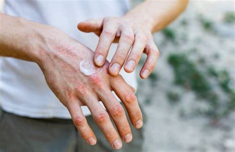 The Downside of Powerful Eczema Creams: Understanding the Risks and ...