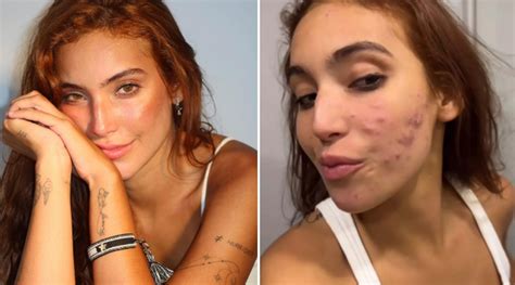 Vanessa Lopes Antes E Depois - Vanessa Lopes mostra antes e depois de acne severa: 'Lembrete que tudo ...