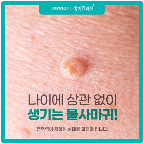 광주 물사마귀 치료에 성공하는 포인트 : 네이버 블로그