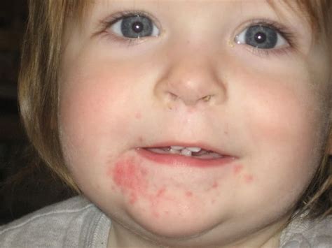 What Causes Rashes Around Your Toddlers Mouth New Kid - vrogue.co