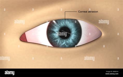 Corneal abrasion hi-res stock photography and images - Alamy