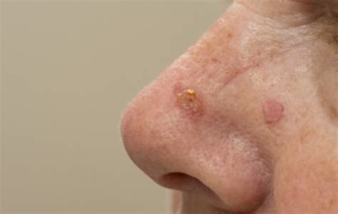 Natural Remedies for Actinic Keratosis | Consumer Health Weekly