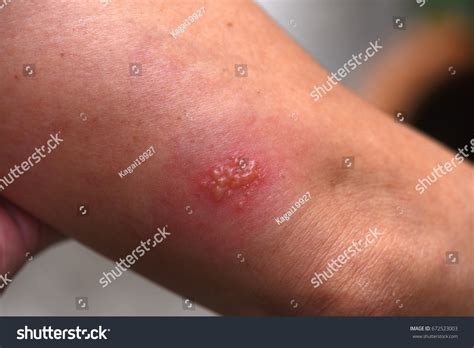Herpes Simplex On Arm Stock Photo 672523003 | Shutterstock