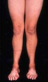 Polyneuropathy Flashcards | Quizlet