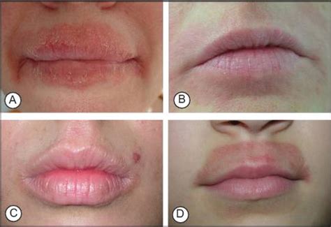 Contact Dermatitis On Lips Images | Lipstutorial.org