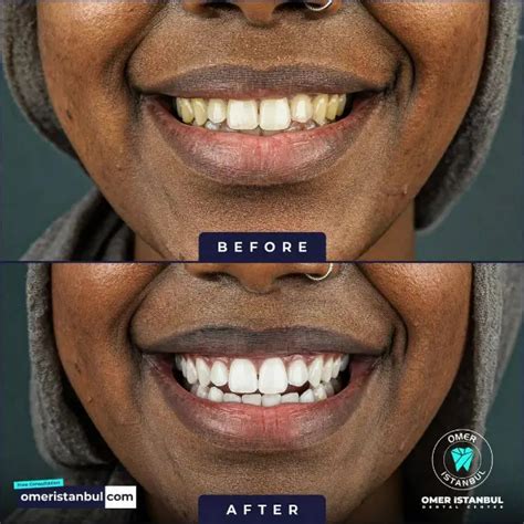 Teeth Whitening in Turkey: Get a Brighter, Whiter Smile Instantly