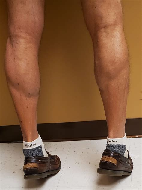 WHAT CAN I DO FOR MY SWELLING ANKLES?