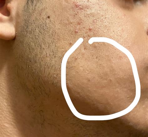 Why my left side is getting fuller but my right one not : r/Minoxbeards