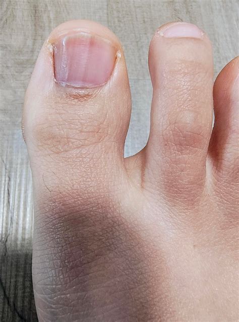 melanonychia vs melanoma??? : r/Melanoma