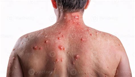 close-up of severe heat rash on the back with inflamed red bumps, sweat