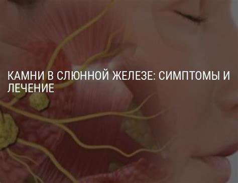 Камни в слюнной железе: симптомы и лечение, причины, народные средства