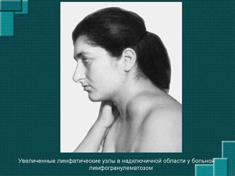 Лимфаденопатия. Основные заболевания с синдромом лимфаденопатии ...