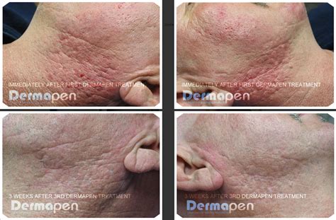 Dermapen Before and After - Cosmetic Skin Institute | Skin Care in ...