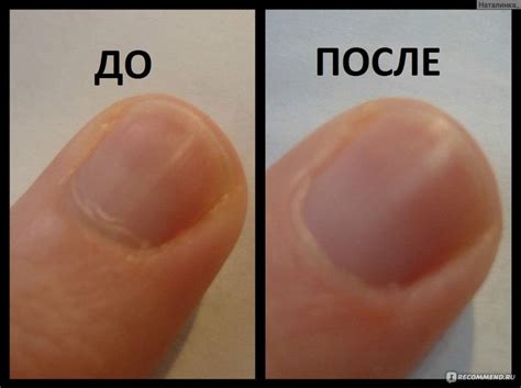 Как убрать кутикулу: удаление без обрезания в домашних условиях, как ...