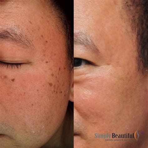 Laser Age Warts Removal - Dr Peter Kim Surgery - Skin Cancer, Cosmetic ...