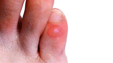 water blister       water blister treatment