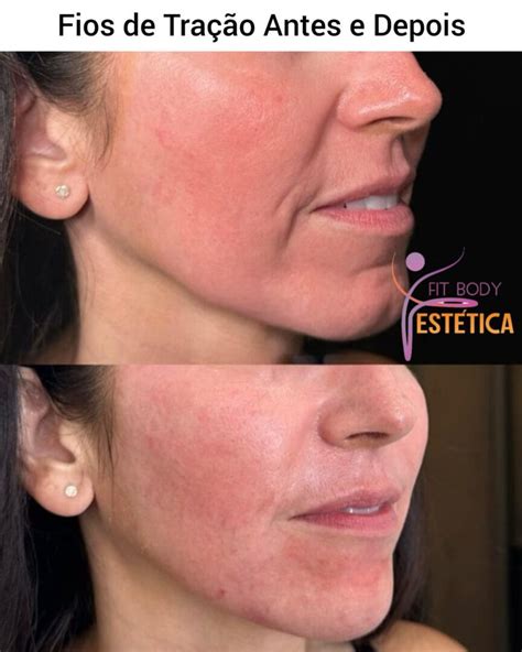 Fios De Tração Antes E Depois - Fios de Tração Antes e Depois - Clínica Fit Body Estética