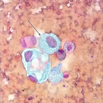 Pericardial fluid cytology background bleeding, changes in mesothelial ...