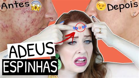 Como Não Ter Mais Espinhas - DICAS INCRÍVEIS PARA NUNCA MAIS TER ESPINHAS | Adeus pele craquenta ...
