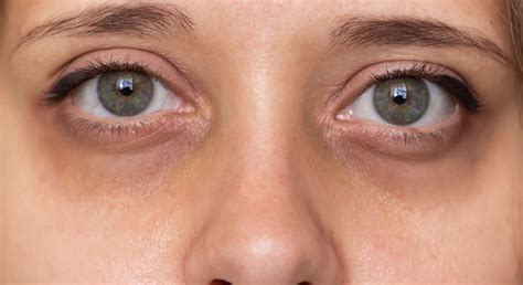 donkere kringen onder de ogen oorzaken aanpak huidexpert