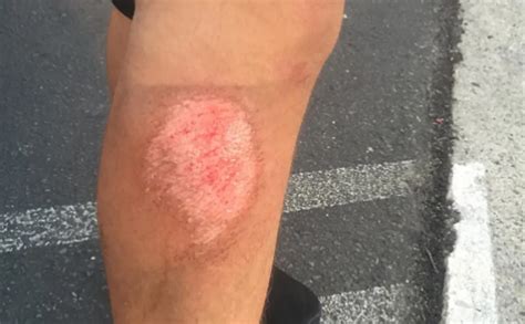 how long do turf burns take to heal