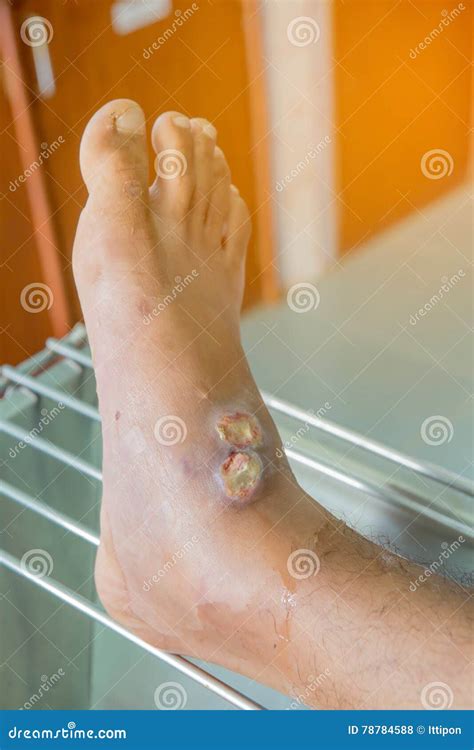 Infected wound stock photo. Image of foot, body, medical - 78784588