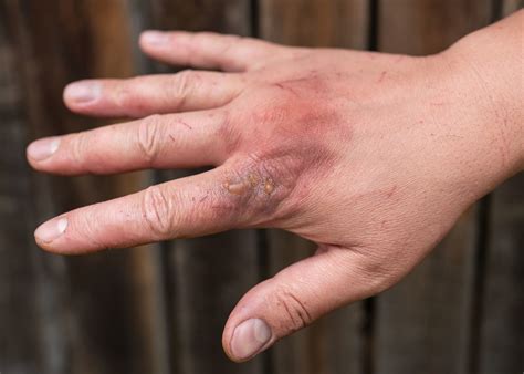 Burns And Heat Injury Treatment First Aid For 2023