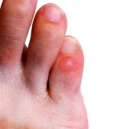 Infected Blister On Bottom Of Foot Clearance | emergencydentistry.com