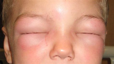 Facial Swelling: Causes, Symptoms, Treatments, and More
