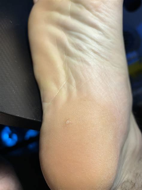 What’s this white spot on my heel? : r/medical