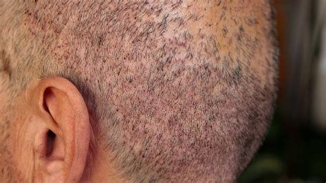 hair transplant infection symptoms - Shaunte Macias