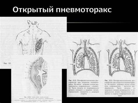Повреждения грудной клетки - презентация онлайн