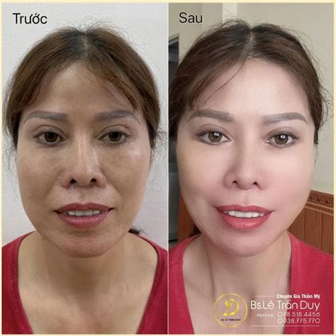 phau thuat cang da mat la gi duoc bao lau dieu  biet