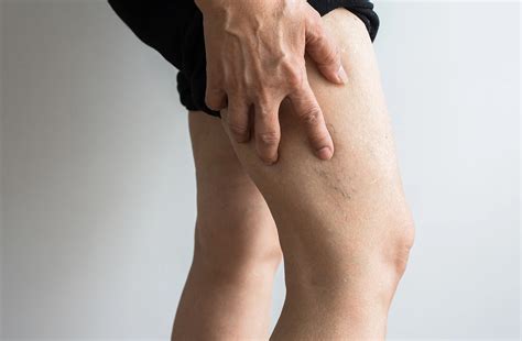 Leg Spider Vein Removal: Your Comprehensive Guide to Smoother, Clearer Legs