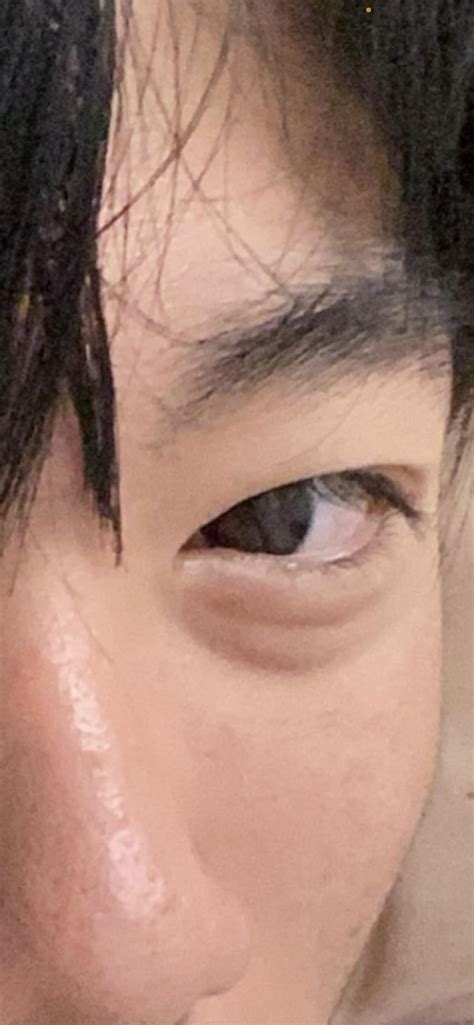 HOW CAN I GET RID OF MY EYEBAGS? : r/DermatologyQuestions