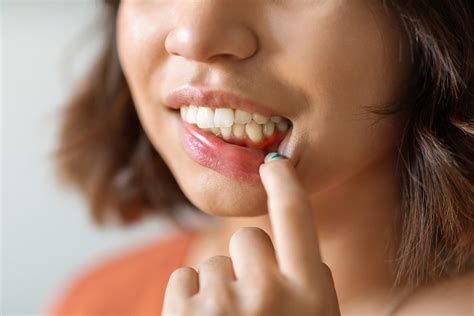 Bump on Gums: Causes and Treatment - cosmedicadental.com