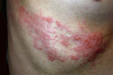 shingles pictures  pictures pushe